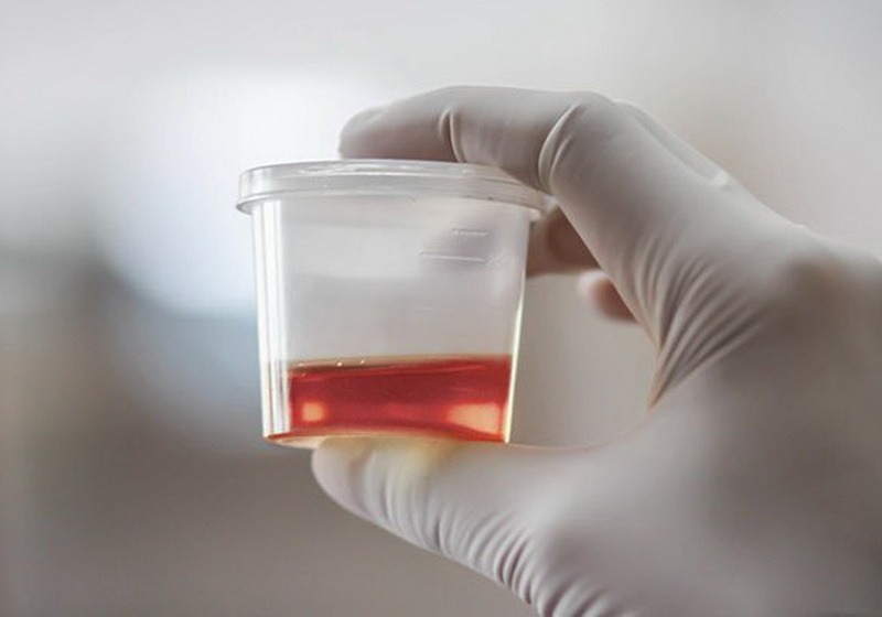 Hematurie (sange in urina) – cauze si tratament
