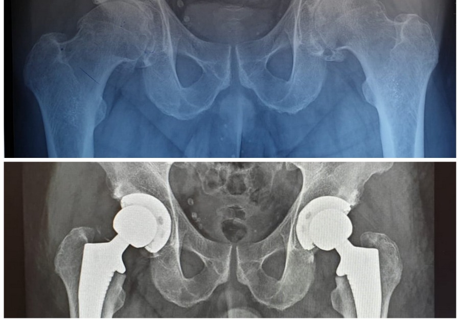 Radiografie pacient cu coxartroză - înainte și după operație